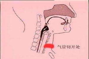 喉乳头状瘤的发病特点