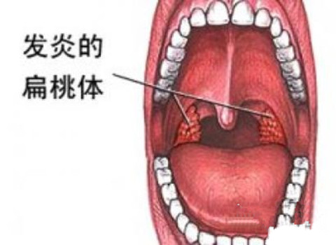 扁桃体炎治疗的方法有哪些