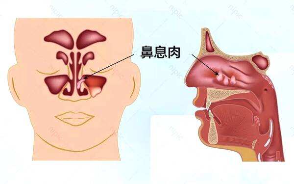 鼻息肉的症状有哪些