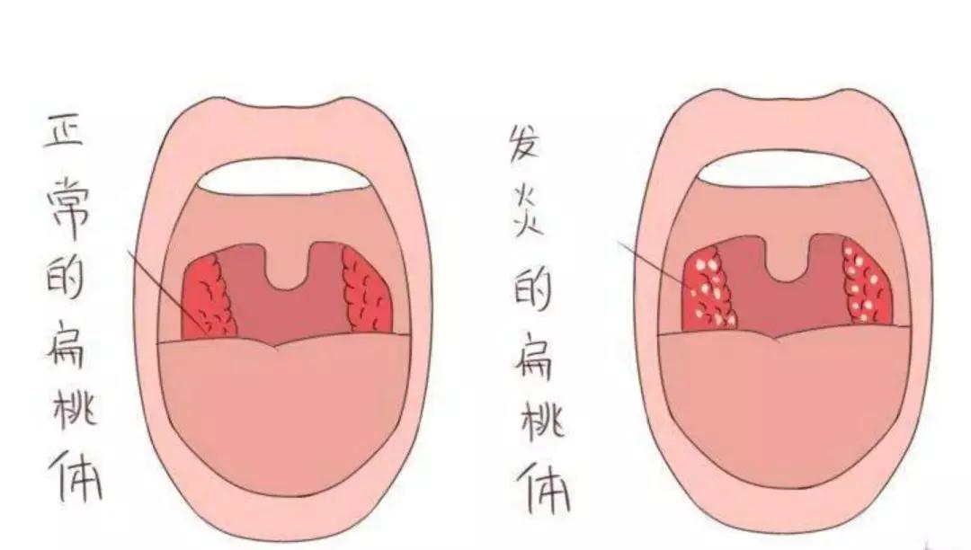 扁桃体炎的症状表现