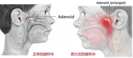 腺样体肥大的危害有哪些