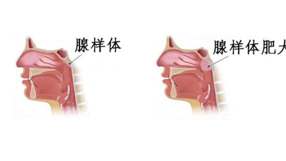 腺样体肥大怎么治疗