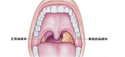 怎么治疗扁桃体炎
