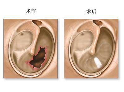 鼓膜穿孔的症状