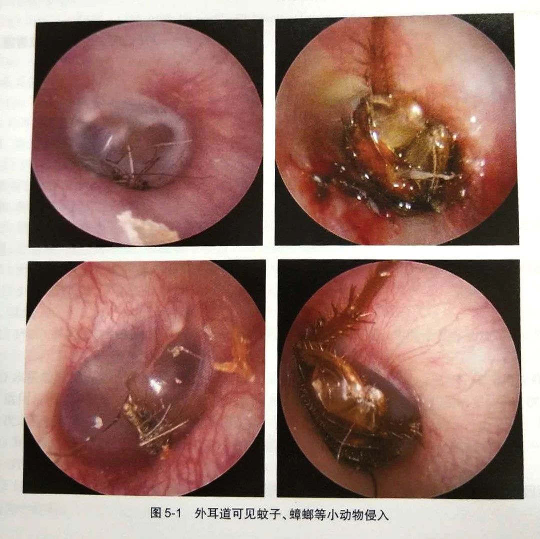 外耳道异物的类型