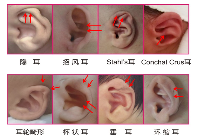 小耳畸形类型